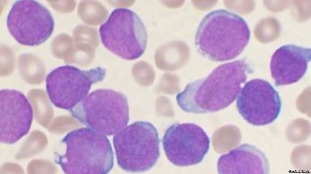 Prometedora inmunoterapia ayuda a adultos con leucemia