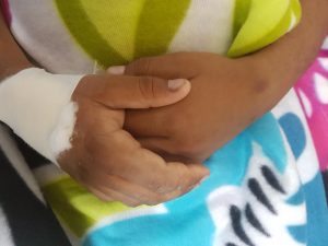 Tercer niño ingresa al Materno Infantil con quemaduras de segundo y tercer grado