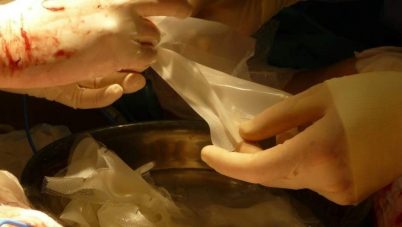 trasplante de piel