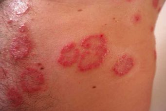 La primera máquina para tratamiento de psoriasis y kativí llegará al Catarino Rivas