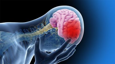 accidente cerebrovascular