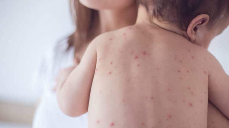 Los casos de sarampión, una enfermedad extremadamente contagiosa, aumentaron más de un 30% en el mundo en 2017