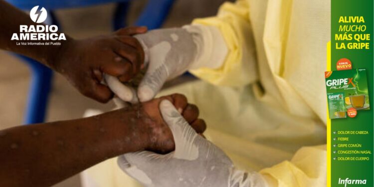 OMS declara nuevamente el mpox como una emergencia internacional de salud pública