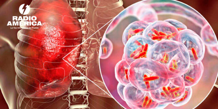 Tuberculosis_radioamérica jpg