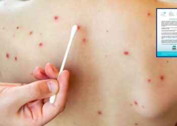 Las autoridades de Salud activaron una alerta sanitaria por sarampión, la medida busca reforzar la vigilancia epidemiológica en el país.
