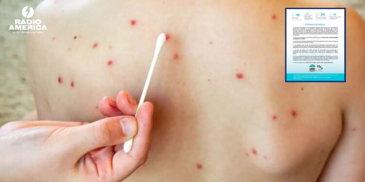 Las autoridades de Salud activaron una alerta sanitaria por sarampión, la medida busca reforzar la vigilancia epidemiológica en el país.