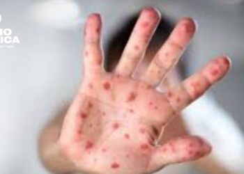 Panamá confirma dos casos de sarampión importados pero descarta transmisión interna