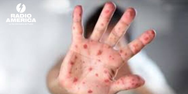 Panamá confirma dos casos de sarampión importados pero descarta transmisión interna