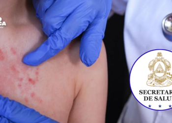 Sarampión en Honduras: Salud reporta más de 200 casos sospechosos y refuerza vigilancia epidemiológica