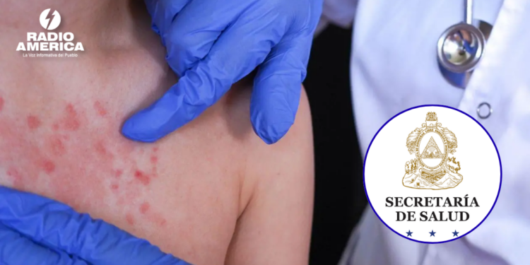 Sarampión en Honduras: Salud reporta más de 200 casos sospechosos y refuerza vigilancia epidemiológica